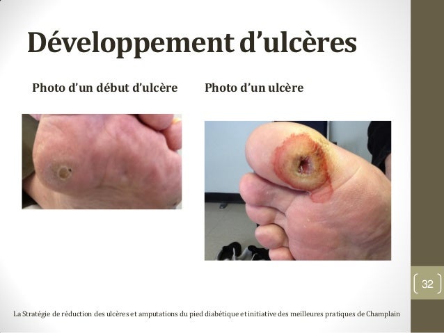 ulcere pieds diabetique ulcere pieds diabetique